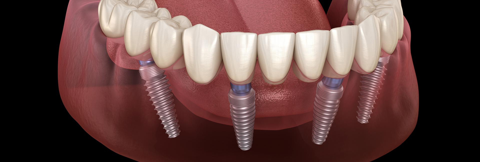 Mandibular prosthesis All on 4 system supported by implants
