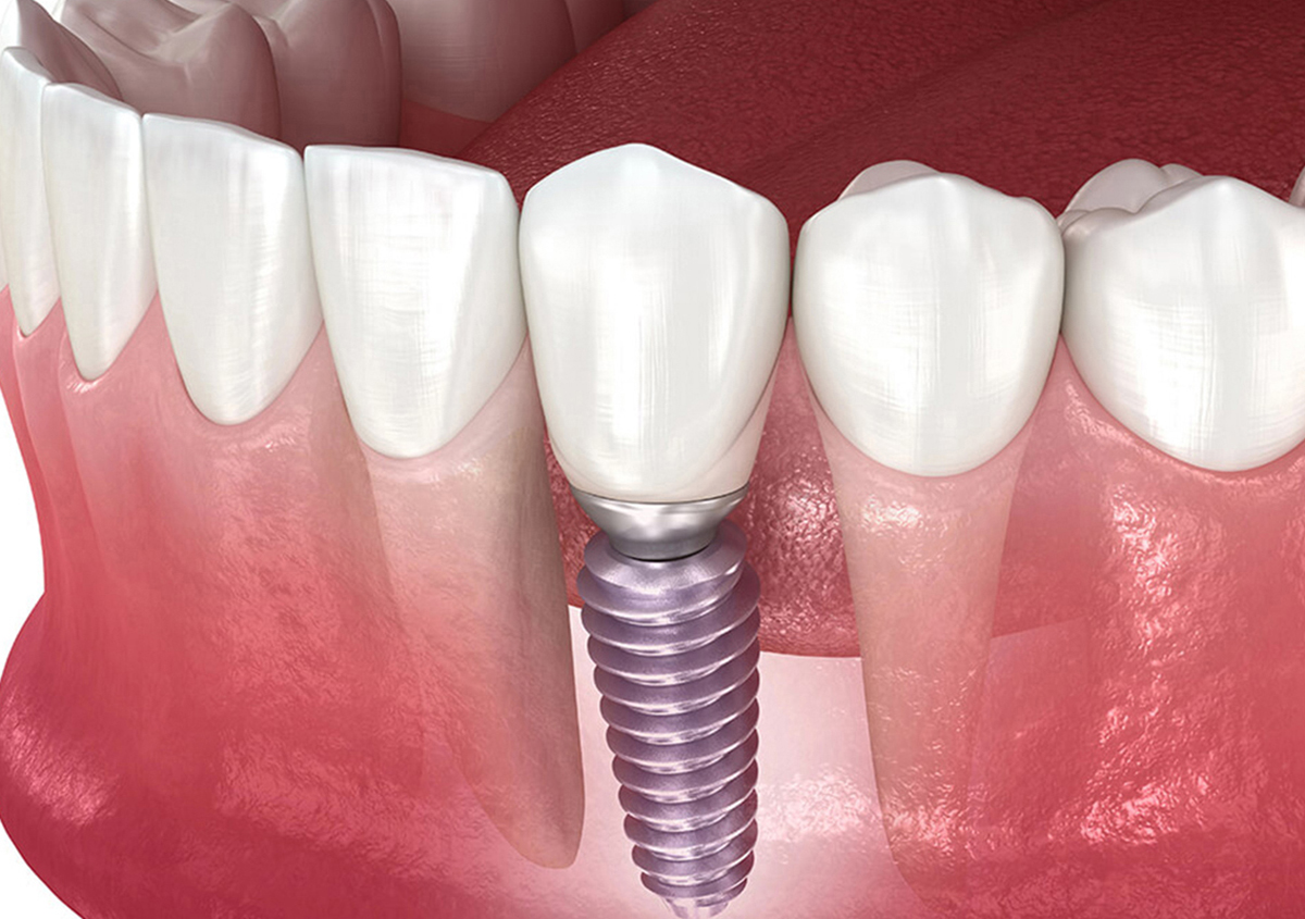 3D illustration of dental implant in Berwyn IL showing crown, abutment, and healing process in jawbone